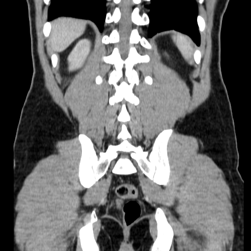 File:Obstructing ureteric calculus (Radiopaedia 18615-18514 C 63).jpg