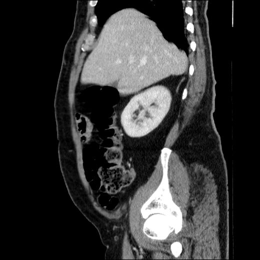 Obstructing ureteric calculus (Radiopaedia 49281-54373 C 67).jpg