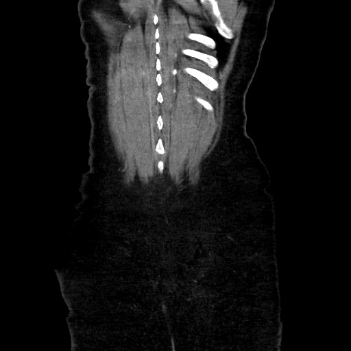 Obstructive distal colonic adenocarcinoma causing cecal perforation (Radiopaedia 86830-102989 C 153).jpg