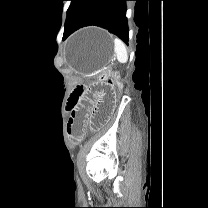 Obturator hernia causing small bowel obstruction (Radiopaedia 65522-74612 C 16).jpg