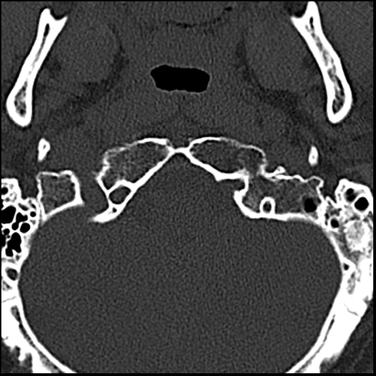 Occipital condyle fracture (type 1) (Radiopaedia 87670-104084 Axial bone window 7).jpg