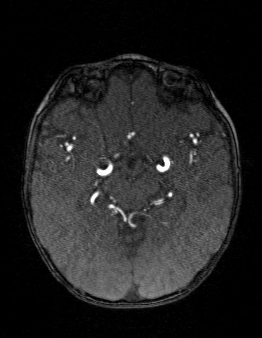 Occipital horn syndrome (Radiopaedia 14255-14129 MRA 72).jpg