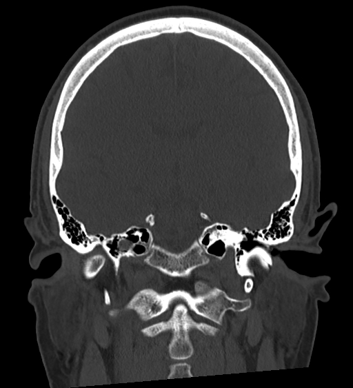 Occipital spur and Currarino type A atlas anomaly (Radiopaedia 87027-103285 Coronal bone window 84).jpg