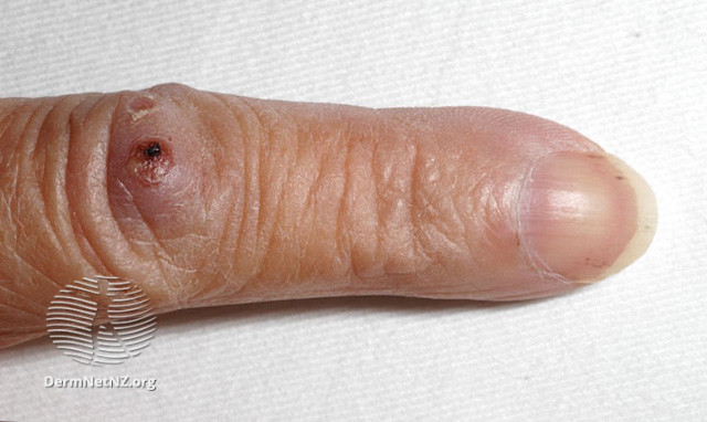 File:Osler nodes on index finger. Note also the tiny splinter haemorrhages on fingernail also seen in end (DermNet NZ systemic-osler2).jpg