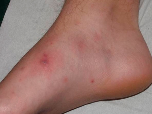 File:Pustules of the foot.png