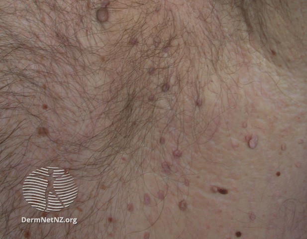 File:Seborrhoeic keratosis (DermNet NZ lesions-tag3).jpg