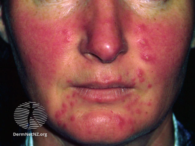 File:Severe erythema, papules and pustules (DermNet NZ acne-rosacea1).jpg