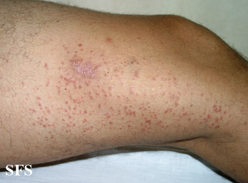 File:Syringoma (Dermatology Atlas 16).jpg