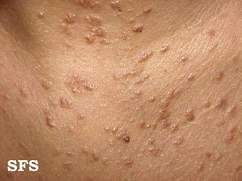 File:Syringoma (Dermatology Atlas 6).jpg