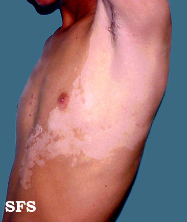 File:Vitiligo (Dermatology Atlas 12).jpg