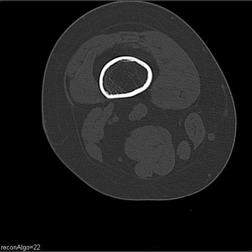 File:ACL avulsion fracture (Radiopaedia 33833-34994 Axial bone window 2).jpg