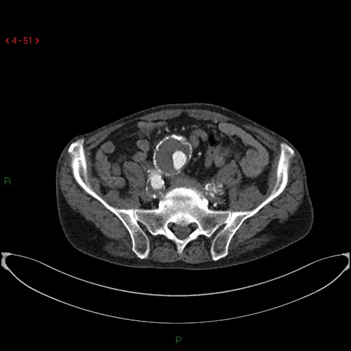 File:Abdominal aortic aneurysm (Radiopaedia 16155-15834 Axial C+ arterial phase 31).jpg