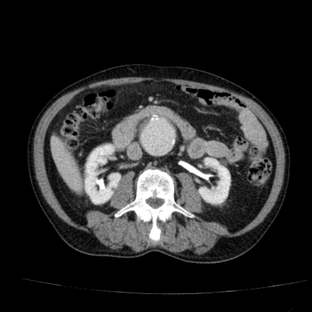 Abdominal aortic aneurysm (Radiopaedia 29248-29660 Axial C+ portal venous phase 29).jpg