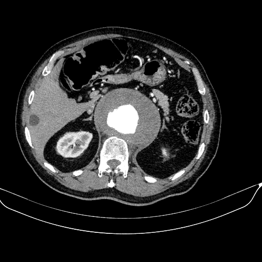 Abdominal aortic aneurysm (Radiopaedia 67117-76452 Axial C+ arterial phase 41).jpg