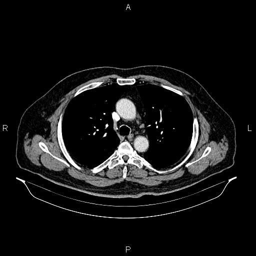 Abdominal aortic aneurysm (Radiopaedia 83094-97462 Axial renal cortical phase 29).jpg