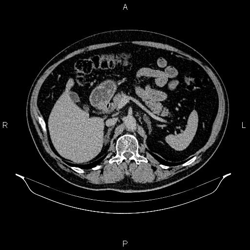 Abdominal aortic aneurysm (Radiopaedia 83094-97462 Axial renal excretory phase 37).jpg