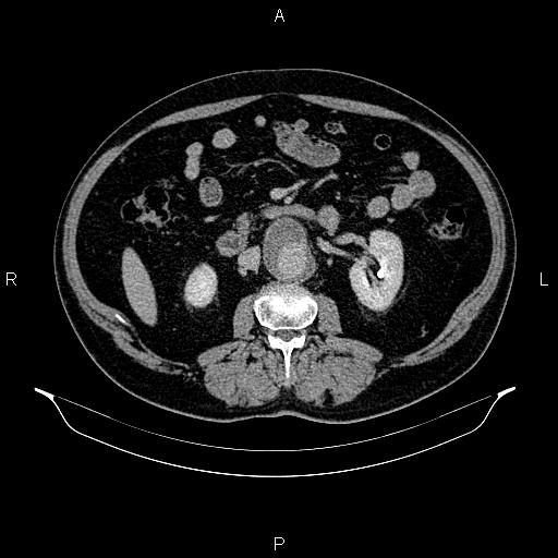 Abdominal aortic aneurysm (Radiopaedia 83094-97462 Axial renal excretory phase 48).jpg