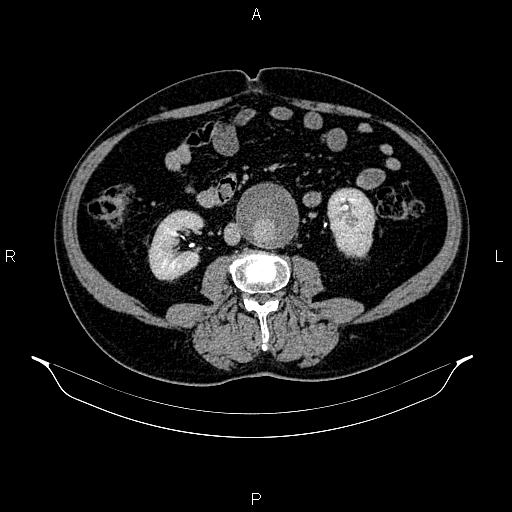 Abdominal aortic aneurysm (Radiopaedia 83094-97462 Axial renal excretory phase 57).jpg