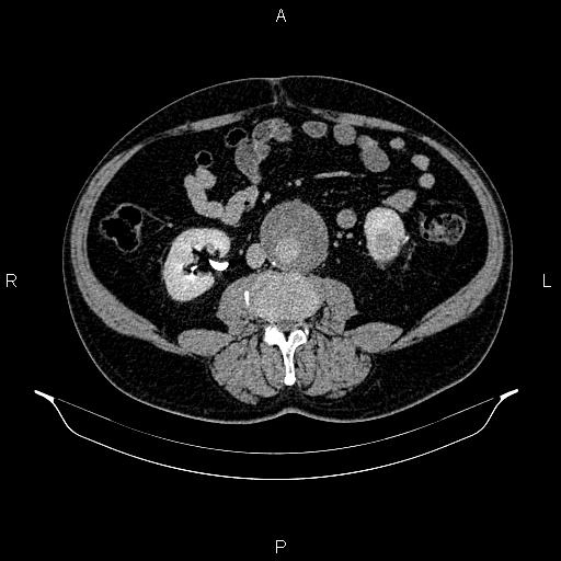 Abdominal aortic aneurysm (Radiopaedia 83094-97462 Axial renal excretory phase 59).jpg
