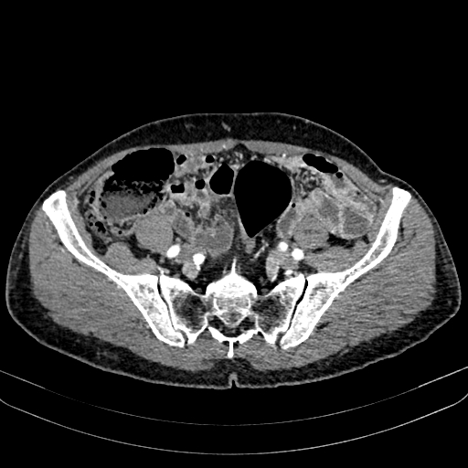 Abdominal aortic aneurysm (Radiopaedia 83581-98689 Axial C+ arterial phase 89).jpg