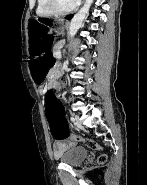 Abdominal aortic aneurysm (Radiopaedia 83581-98689 Sagittal C+ portal venous phase 69).jpg