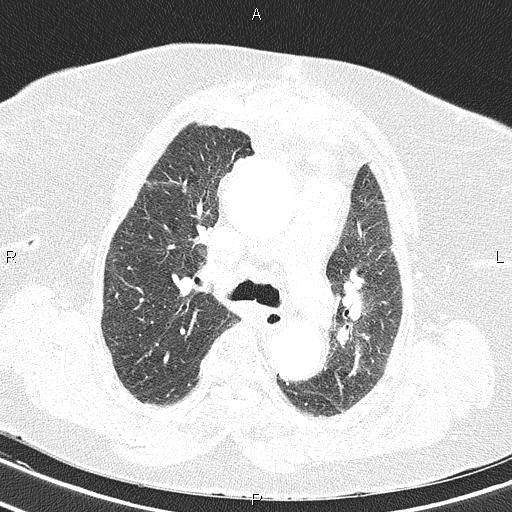 Abdominal aortic aneurysm (Radiopaedia 85063-100606 Axial lung window 27).jpg