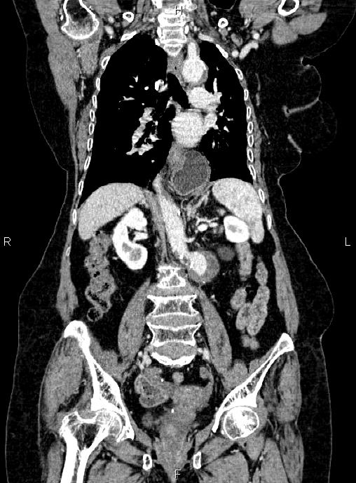 Abdominal aortic aneurysm (Radiopaedia 85063-100606 Coronal C+ arterial phase 33).jpg