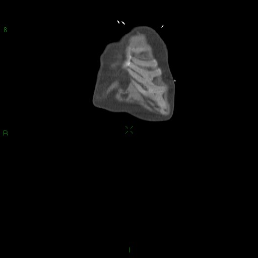File:Abdominal aortic aneurysm rupture with aortocaval fistula (Radiopaedia 14897-14841 Coronal C+ arterial phase 10).jpg