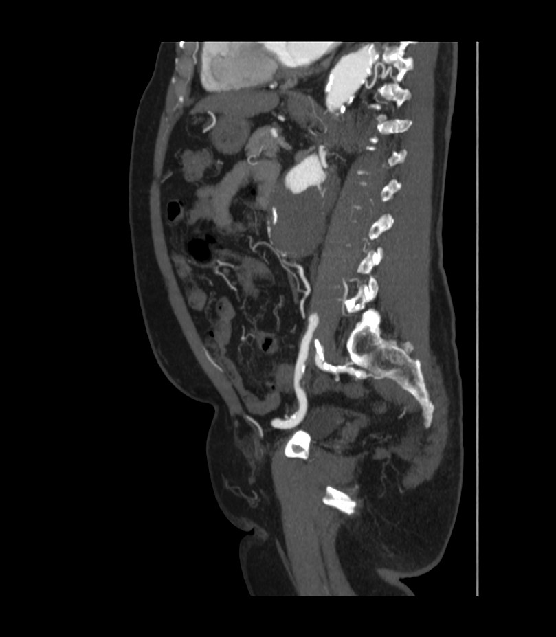 Abdominal aortic aneurysm with thrombus fissuration (Radiopaedia 46218-50618 Sagittal C+ arterial phase 36).jpg