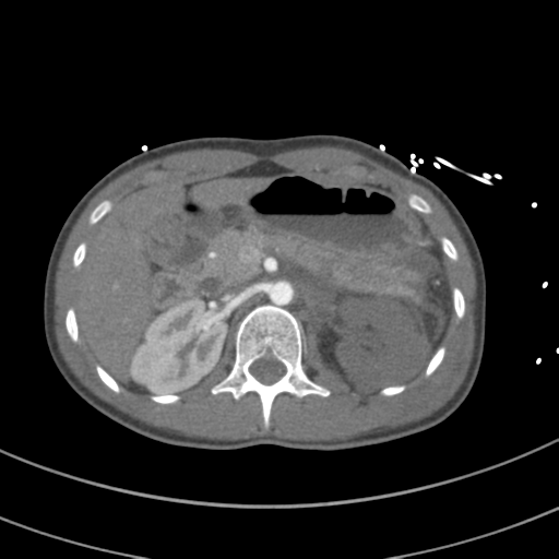 Abdominal multi-trauma - devascularised kidney and liver, spleen and pancreatic lacerations (Radiopaedia 34984-36486 Axial C+ arterial phase 102).png