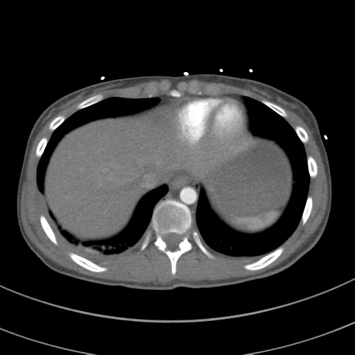 File:Abdominal multi-trauma - devascularised kidney and liver, spleen and pancreatic lacerations (Radiopaedia 34984-36486 Axial C+ arterial phase 69).png