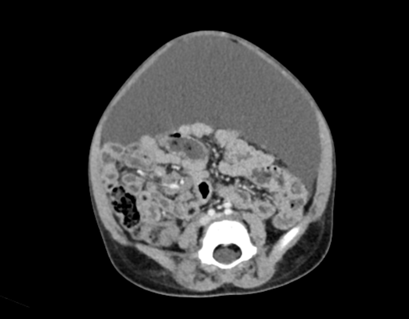Abdominal premesenteric cystic lymphangioma (Radiopaedia 82995-97350 Axial C+ portal venous phase 40).jpg