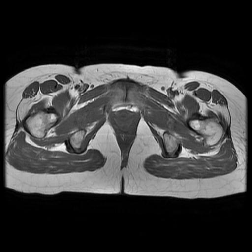 File:Abdominal wall endometriosis (Radiopaedia 83702-98847 Axial T1 18).jpg