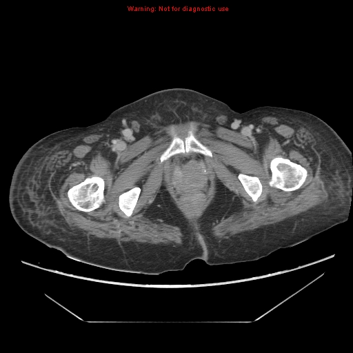 File:Abdominal wall hematoma (Radiopaedia 9427-10112 Axial C+ portal venous phase 110).jpg