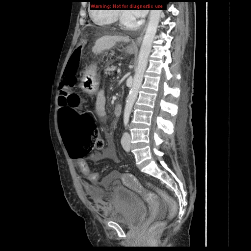 Abdominal wall hematoma (Radiopaedia 9427-10112 Sagittal C+ portal venous phase 49).jpg