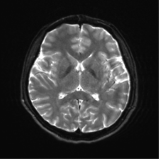 File:Abducens nerve palsy (Radiopaedia 51069-56648 Axial DWI 14).png