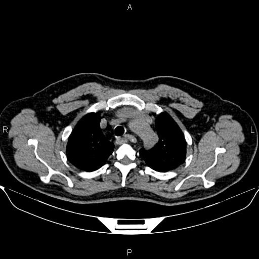 Aberrant right subclavian artery (Radiopaedia 87093-103354 Axial non-contrast 23).jpg