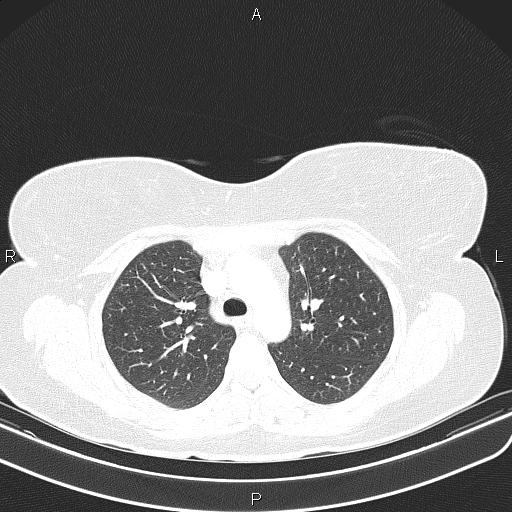 File:Aberrant right subclavian artery (Radiopaedia 87334-103629 Axial lung window 24).jpg