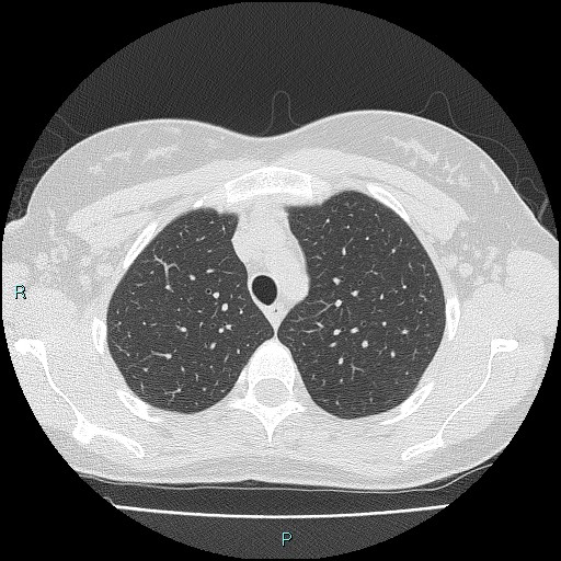 Accidental foreign body aspiration (seamstress needle) (Radiopaedia 77740-89983 Axial lung window 16).jpg