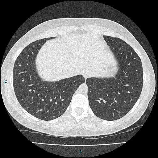File:Accidental foreign body aspiration (seamstress needle) (Radiopaedia 77740-89983 Axial lung window 53).jpg
