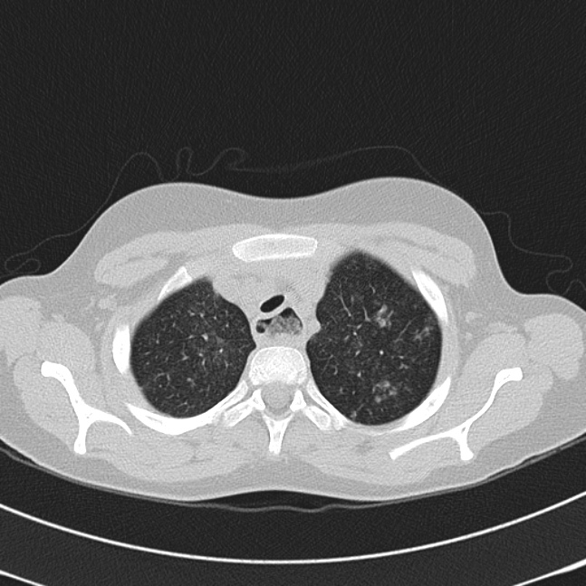Achalasia (Radiopaedia 14946-14878 Axial lung window 10).jpg