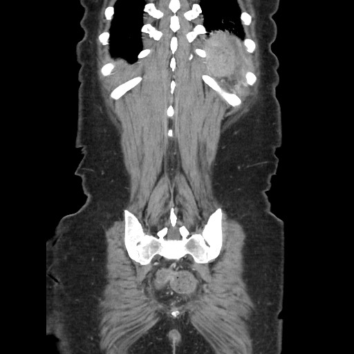 File:Acinar cell carcinoma of the pancreas (Radiopaedia 75442-86669 Coronal C+ portal venous phase 110).jpg