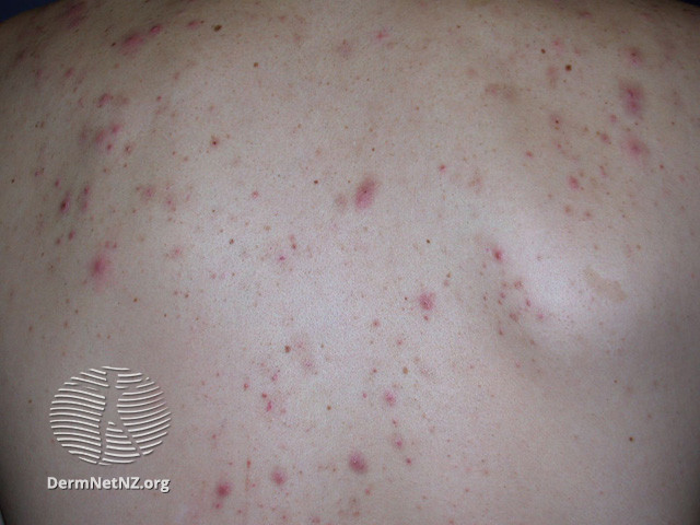 File:Acne affecting the back images (DermNet NZ acne-acne-back-176).jpg