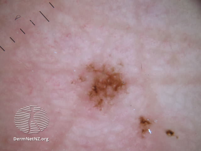 File:Acral lentiginous melanoma dermoscopy (DermNet NZ acral-lentiginous-melanoma-2).jpg
