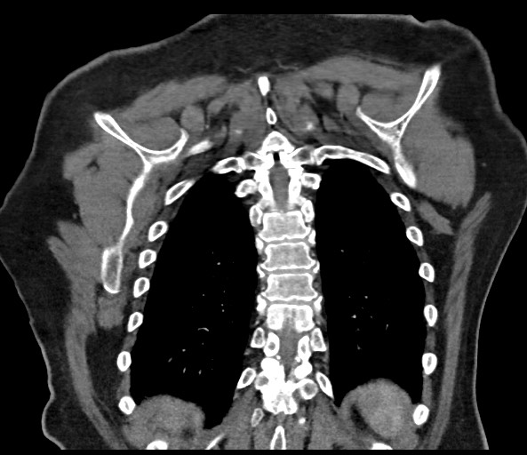 Acromioclavicular joint cyst (Radiopaedia 58455-65610 Coronal C+ arterial phase 116).jpg