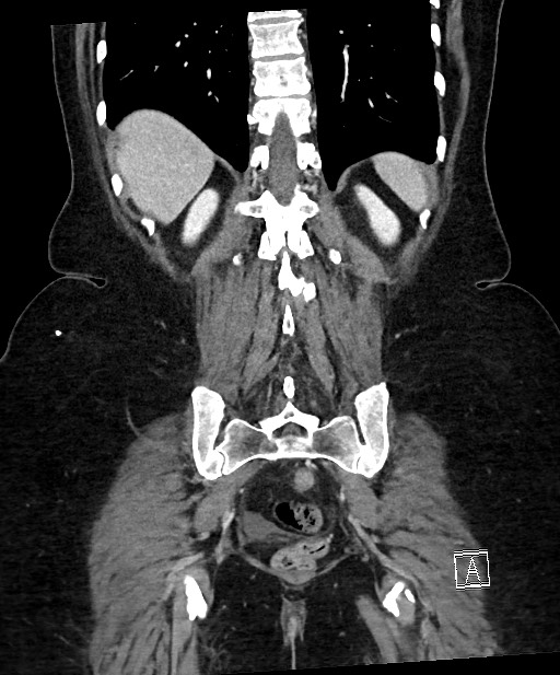 Active Crohn disease (Radiopaedia 59394-66750 Coronal C+ portal venous phase 55).jpg
