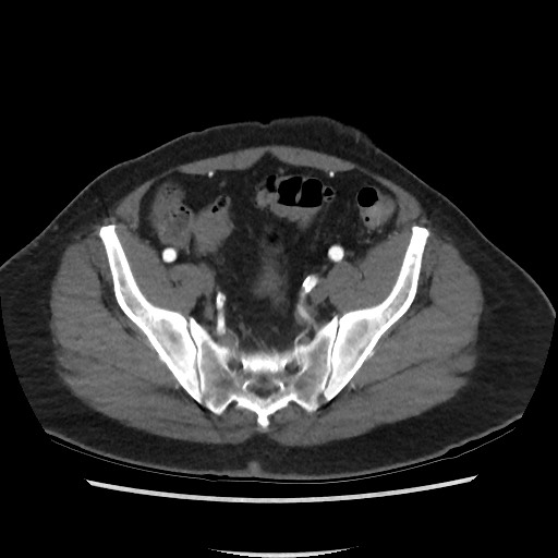 Active colonic bleed on CT (Radiopaedia 49765-55025 Axial C+ arterial phase 66).jpg