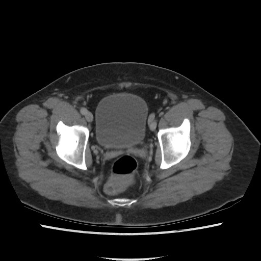 File:Active colonic bleed on CT (Radiopaedia 49765-55025 Axial C+ delayed 75).jpg