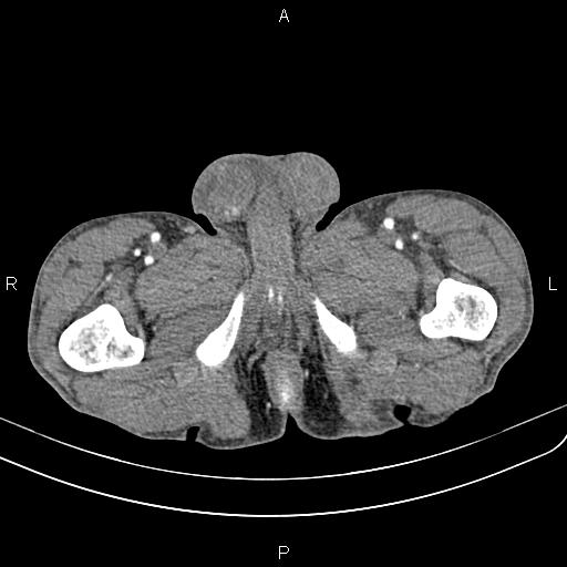 Active crohn disease (Radiopaedia 87133-103397 Axial C+ arterial phase 113).jpg