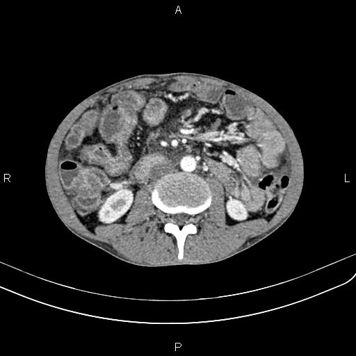 Active crohn disease (Radiopaedia 87133-103397 Axial C+ arterial phase 54).jpg